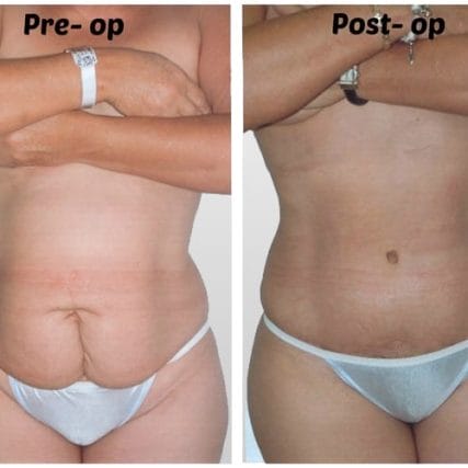 tummy-tuck-addominoplasty-miami-carlos-spera-24