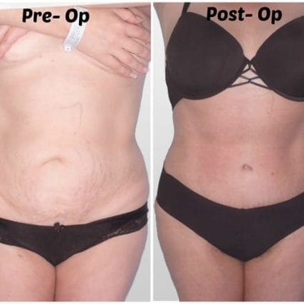 tummy-tuck-addominoplasty-miami-carlos-spera-25