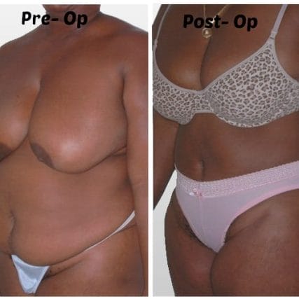 tummy-tuck-addominoplasty-miami-carlos-spera-26