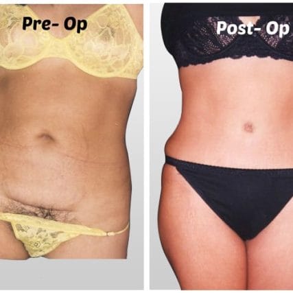 tummy-tuck-addominoplasty-miami-carlos-spera-27