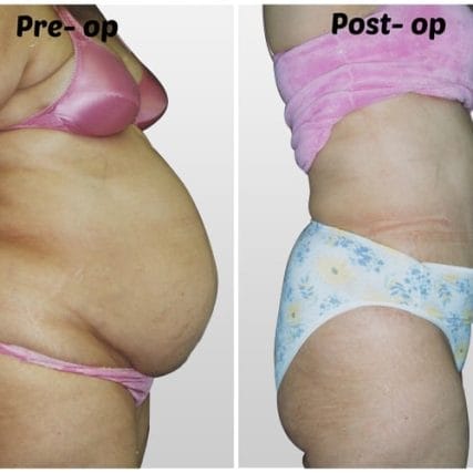 tummy-tuck-addominoplasty-miami-carlos-spera-28