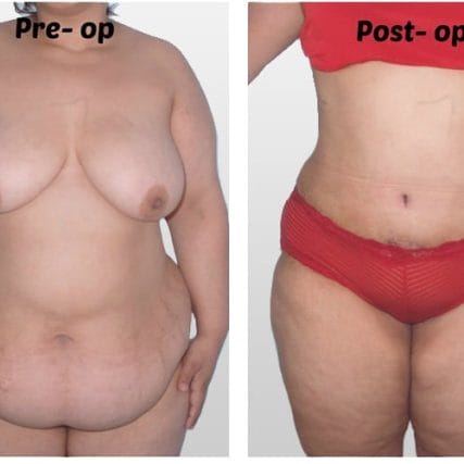 tummy-tuck-addominoplasty-miami-carlos-spera-30