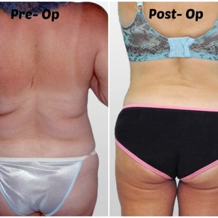 tummy-tuck-addominoplasty-miami-carlos-spera-31