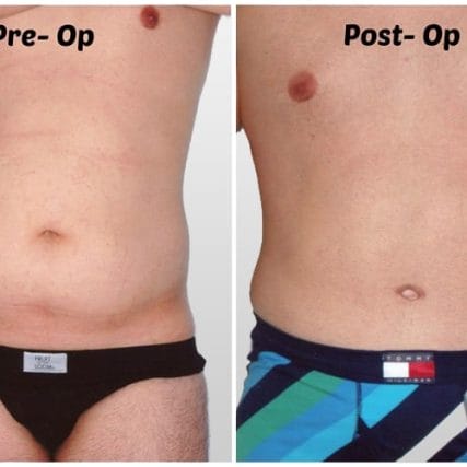 tummy-tuck-addominoplasty-miami-carlos-spera-33