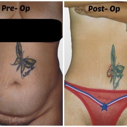 tummy-tuck-addominoplasty-miami-carlos-spera-34