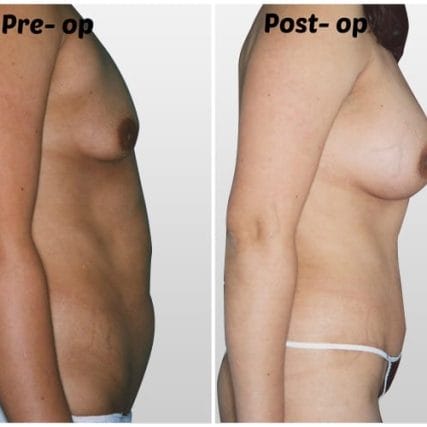 tummy-tuck-addominoplasty-miami-carlos-spera-38