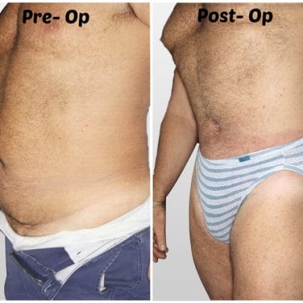 tummy-tuck-addominoplasty-miami-carlos-spera-45