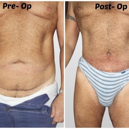 tummy-tuck-addominoplasty-miami-carlos-spera-56